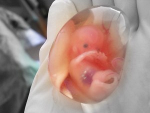 Human fetus 10 weeks therapeutic abortion